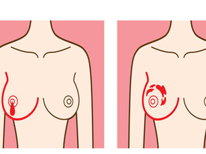 每4人就有1個是乳癌！乳房病變時的七大無痛症狀，胸部周圍出現這種硬塊立刻就醫｜每日健康 Health