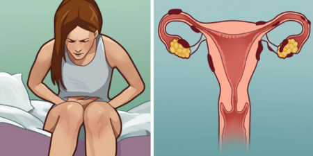 妳常常經痛、腹瀉？一直無法懷孕？若有這些症狀，當心是「子宮內膜異位症」！