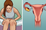 妳常常經痛、腹瀉？一直無法懷孕？若有這些症狀，當心是「子宮內膜異位症」！
