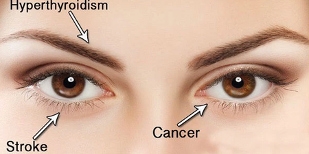  「眼睛」反覆長出「針眼」竟是腫瘤前兆？眼睛反映身體病變的「八大癥狀」，不可不知。