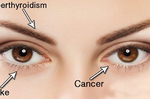  「眼睛」反覆長出「針眼」竟是腫瘤前兆？眼睛反映身體病變的「八大癥狀」，不可不知。