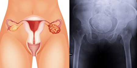 卵巢癌5年存活率不到1成！癌細胞原來都長在女性這部位，肚子痛、骨盆痠四徵兆馬上就醫｜每日健康Health