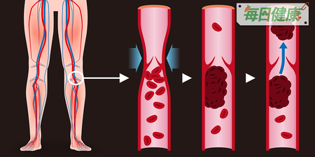 咳嗽、水腫非小事，恐怕是靜脈血栓在作祟，不想飛機上中風發作，「六大徵兆」一次秒懂