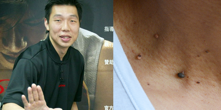 前職籃球員熊仁正45歲就因皮膚癌過世，「痣」的四大檢測法，一秒自測，提早發現｜每日健康 Health