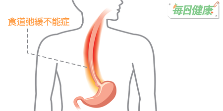 胃酸逆流、吃下去的食物積到胸口？小心罹患「食道弛緩不能症」爆瘦成疾 ｜每日健康 Health