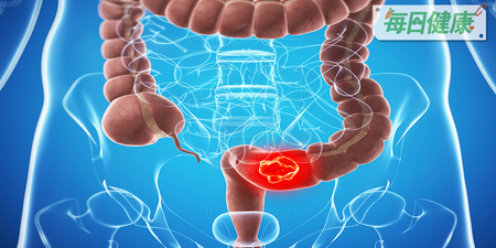 缺乏維生素D，才是「大腸癌」真正元兇？日醫獨門日光浴療法防13種癌｜每日健康 Health