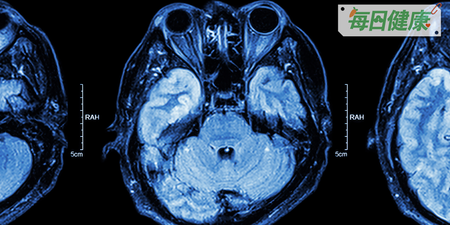 13歲女童頭痛持續兩周當感冒，竟是可怕「室管膜瘤」，嚴重可能猝死｜每日健康 Health