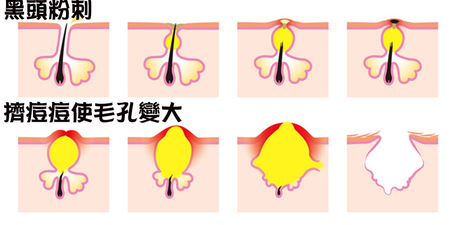 「粉刺=深水炸彈」用手擠、摳，小心使你的青春留上疤—–9 大隱形殺手，你的『毛孔』夠安全嗎？