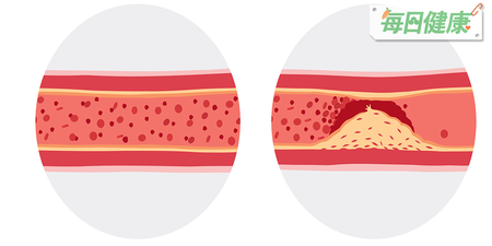 血脂達多少就可能「血管硬掉」？專家說達這數字等於血管埋炸彈｜每日健康 Health