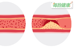 血脂達多少就可能「血管硬掉」？專家說達這數字等於血管埋炸彈｜每日健康 Health