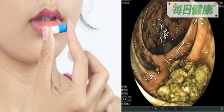 吃個藥竟食道被燒爛？台灣人最常見服藥3大惡習，嚴重恐食道穿孔傷性命｜每日健康 Health