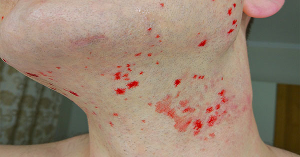 刮胡子究竟该顺著刮还是逆著刮?刮错引发毛囊炎恐留疤|每日健康