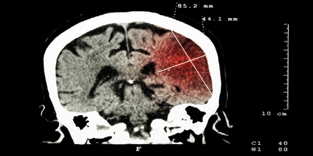 什麼是小中風？頭痛、手腳痲...認識腦血管崩潰前5大徵兆｜每日健康 Health