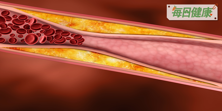 「血濁」、「血稠」恐是遺傳　年輕患者易併發心肌梗塞｜每日健康 Health
