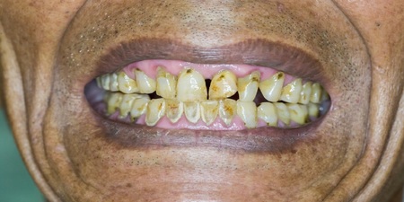 牙齒不好是「小弟弟」崩潰預兆？研究：53%勃起障礙有關｜每日健康 Health