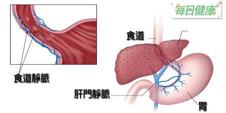 【肝衛人生】比肝癌更危險的事：肝硬化恐引起食道出血甚至猝死｜每日健康 Health