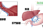 【肝衛人生】比肝癌更危險的事：肝硬化恐引起食道出血甚至猝死｜每日健康 Health