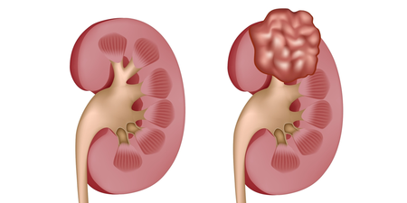 感冒沒治好會變急性腎炎？高血壓會引起慢性腎病？榮總醫師說分明｜每日健康 Health