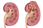 感冒沒治好會變急性腎炎？高血壓會引起慢性腎病？榮總醫師說分明｜每日健康 Health