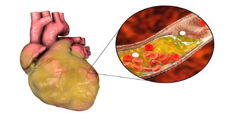 高血脂傷腦、傷心臟　早上一晚燕麥粥能降脂｜每日健康 Health