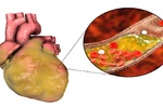 高血脂傷腦、傷心臟　早上一晚燕麥粥能降脂｜每日健康 Health