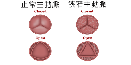 走幾步就喘吁吁，照X光肺卻沒事？小心「主動脈狹窄」變成奪命未爆彈｜每日健康 Health