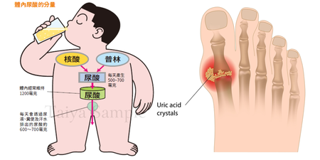 尿酸過高「痛風」怎麼辦？醫師表示：少吃戒酒還不夠｜每日健康 Health