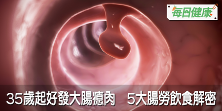 大腸癌機率激增60%！五大「勞腸惡習」讓你養出滿滿的大腸瘜肉｜每日健康 Health