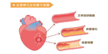 每天都在加速「血管硬化」卻不自知！常出現5症狀速就醫｜每日健康 Health