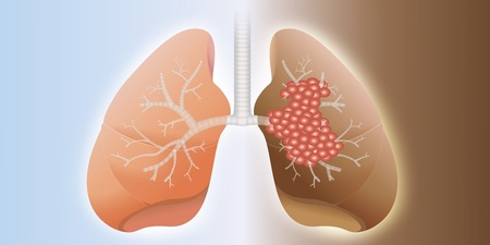 口氣不好非小事　飄出這種味道恐是「肺癌」警訊｜每日健康 Health