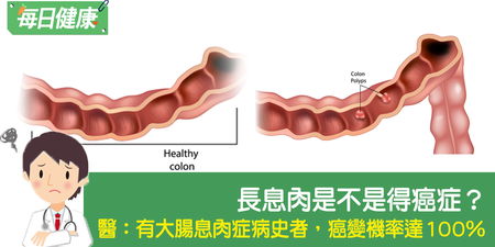 息肉是不是得癌症？切除後還會癌變嗎？陳彥甫營養師說分明｜每日健康 Health