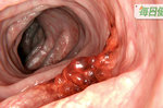 除了血便，這「3大症狀」不注意，可能就已經是大腸癌末期｜每日健康 Health