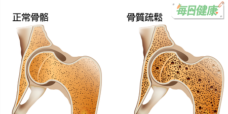 「骨質疏鬆」台灣3人就1個，嚴重連打噴嚏都會骨折｜每日健康 Health