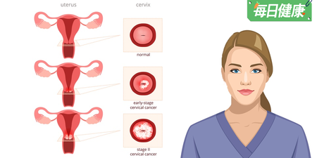肉眼就能判讀是否為「子宮內膜癌」高度罹患者！五特徵中2個就要小心
