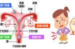 破解「子宮肌瘤」迷思！並不是只有30歲以上婦女才會有！「子宮肌瘤」趨向年輕化，小心這些症狀！