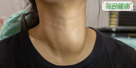 中年工人把粗脖子當甲狀腺腫，錯過喉癌黃金治療期「終身失聲」｜每日健康 Health