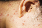 水痘就是皰疹嗎？會如何傳染？初期發病徵兆有哪些？家醫科主任一次說分明