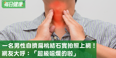 男子自擠扁桃腺結石，網友大呼「好噁心啊！」｜每日健康 Health