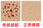 做什麼運動能預防骨質疏鬆？吃什麼食物能補足鈣質？健骨百科大公開