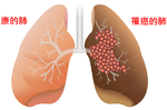 預防「肺癌」請你這麼做！了解致癌因子、察覺發病徵兆、勤練養肺運動