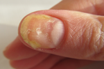 乾癬性關節炎好發率達30%　指甲變黃、頭皮屑變多都是警訊之一