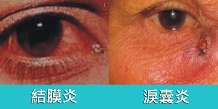 從「眼屎」看健康！結膜炎、淚囊炎、紅眼症病徵一秒看懂