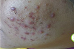 冒痘痘、粉刺多、毛孔大？皮膚科醫師揭4種治療有效抗痘