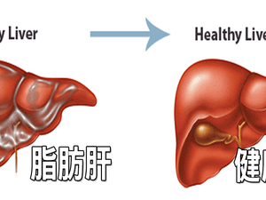 台灣3分之1人口有「脂肪肝」問題，「逆轉脂肪肝」的7大絕招，救肝降脂不能再拖！