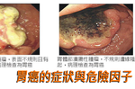 胃癌早期無症狀　內科醫師揭十大致癌因子：原來連血型也有影響？