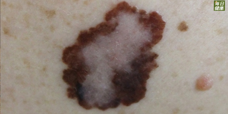 許多人防曬都忽略這部位　皮膚科博士：罹致命皮膚癌率恐爆增2倍！