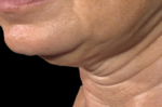 「垂垂鬆弛臉」怎麼救？自製簡易「高麗菜面膜」解除下垂警報，20分鐘內皮膚重新彈起來！