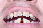 一口爛牙「腎臟」出事機率高四倍？牙周病和腎臟病的驚人真相