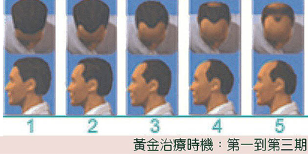 如何察覺自已有沒有雄性禿？皮膚科醫師揭四特徵是關鍵