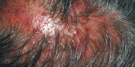 頭皮屑變多恐是「頭癬」在作怪！醫師建議5件事少做避免頭髮掉光光